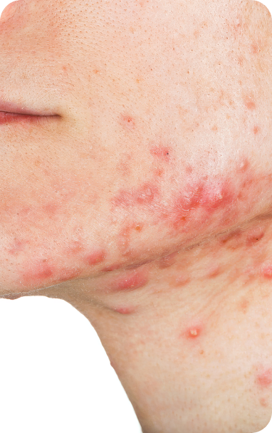 bibiotic derma helps